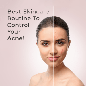 Acne control face serum